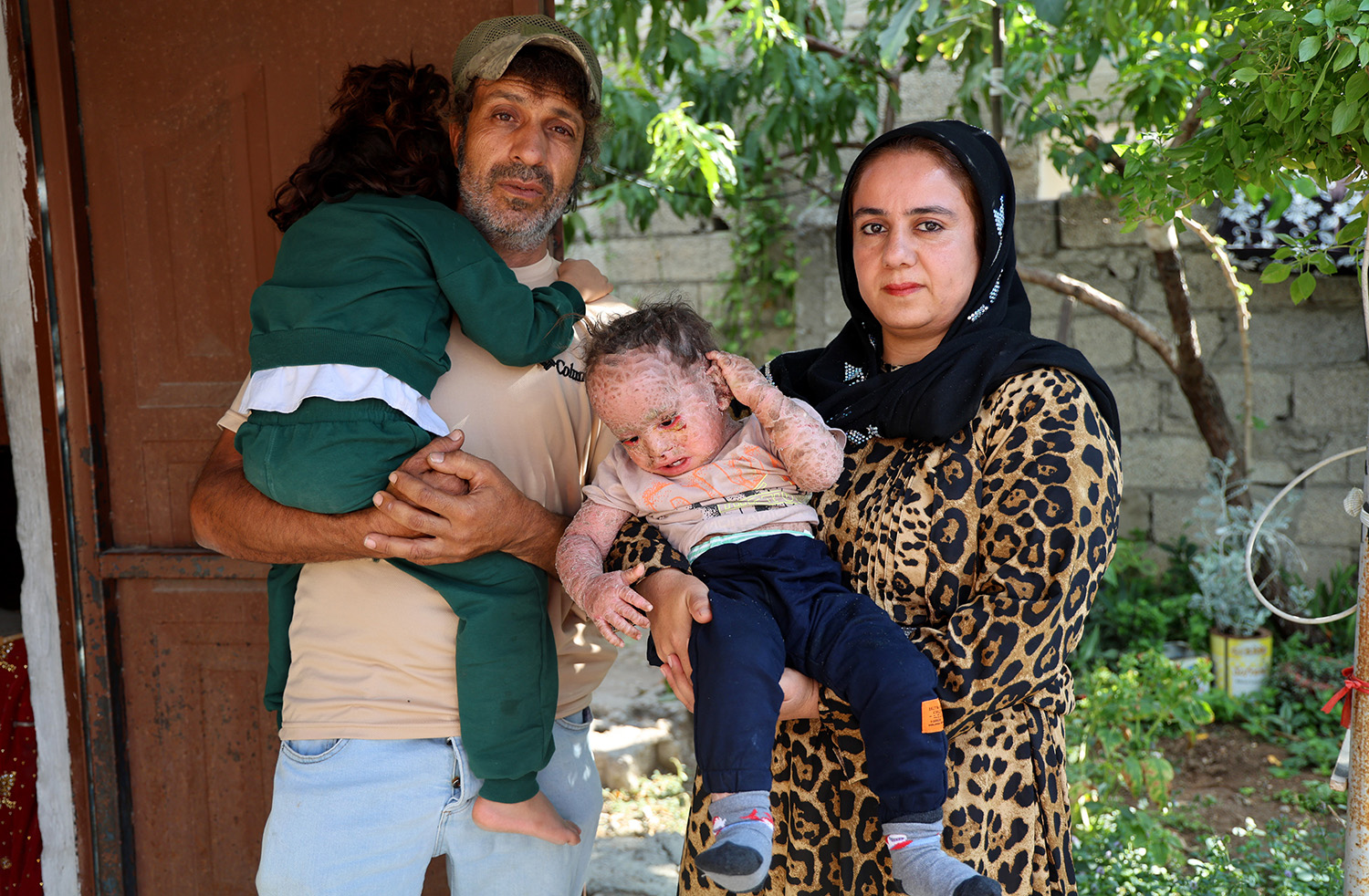 Balık Pulu Ve Kelebek Hastası Yusuf'un Yardım Paralarını Dolandırıcılar Topladı (2)