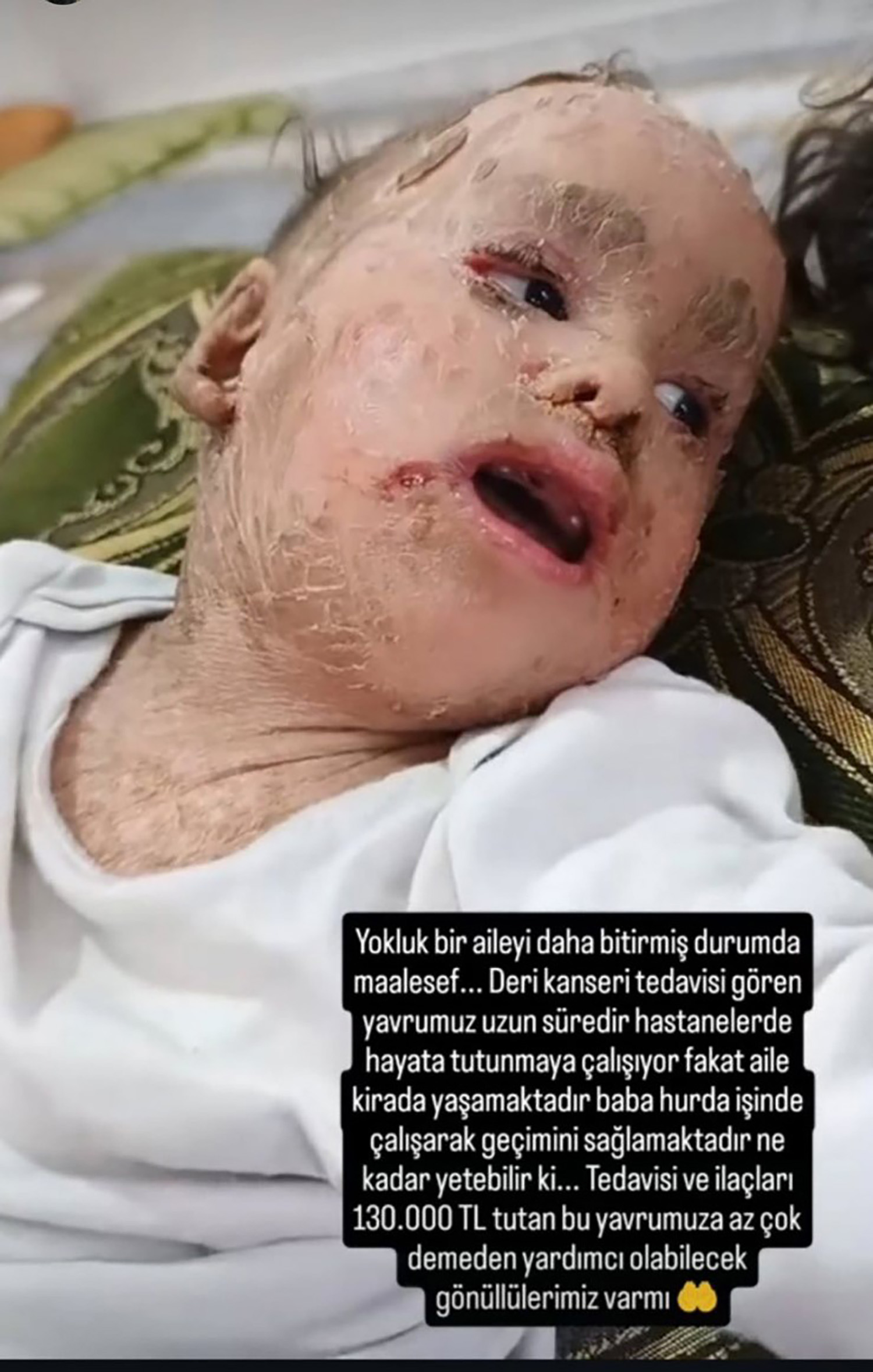 Balık Pulu Ve Kelebek Hastası Yusuf'un Yardım Paralarını Dolandırıcılar Topladı (5)