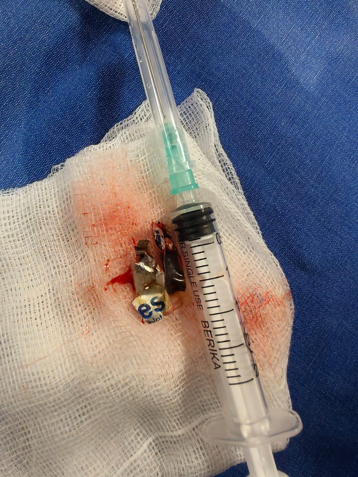 Antalya’da Şaşırtan Vaka! Akciğerdeki Sır 4 Yıl Sonra Çözüldü (5)