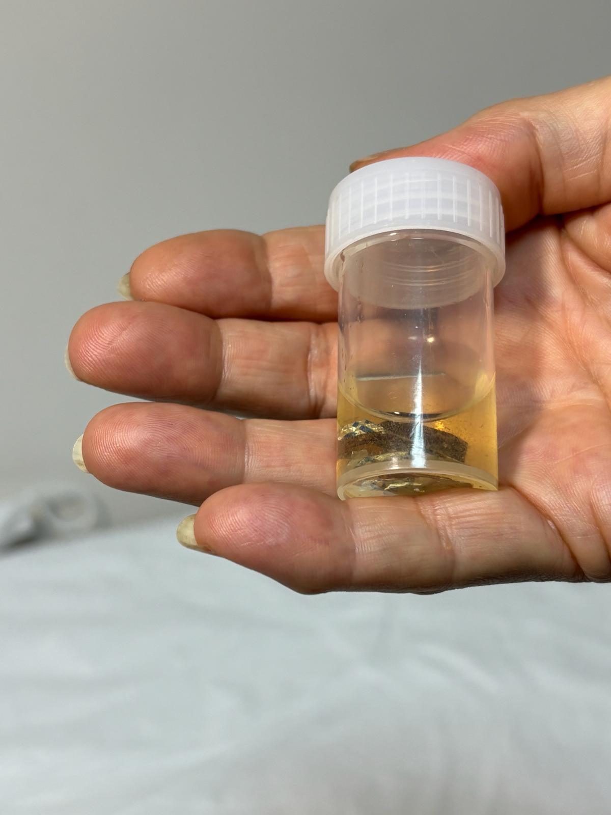 Antalya’da Şaşırtan Vaka! Akciğerdeki Sır 4 Yıl Sonra Çözüldü (6)