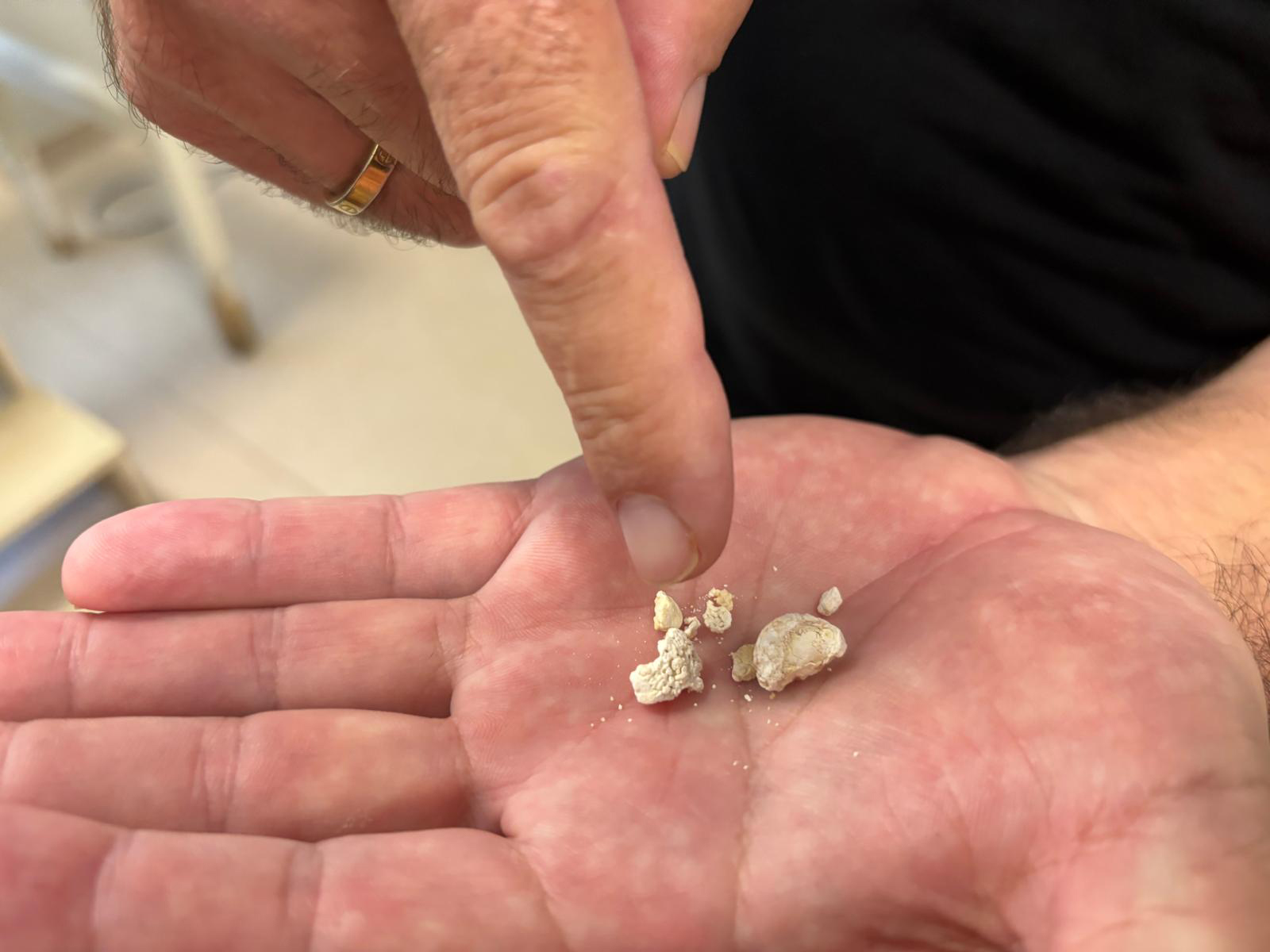 Antalya’da Tükürük Bezinden, 5 Taş Çıkarıldı (5)