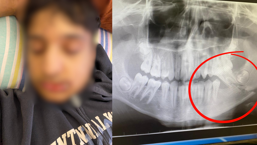 Antalya’daki Lisede Akran Zorbalığı Ve Şiddet Iddiası Öğrencinin Çenesi Kırıldı (3)-1