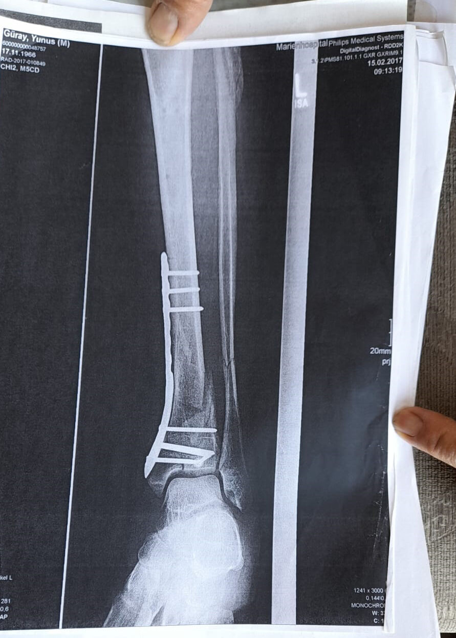 Antalya’da Göz Göre Göre Ihmal Arkeolojik Kazı Çukuruna Düşen Turiste 1 Milyonluk Liralık Tazminat (3)