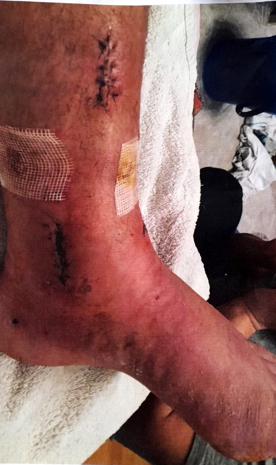 Antalya’da Göz Göre Göre Ihmal Arkeolojik Kazı Çukuruna Düşen Turiste 1 Milyonluk Liralık Tazminat (4)