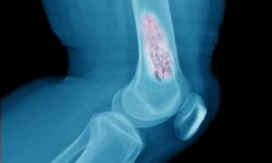 Kemiklerin sessiz düşmanı osteoporoz yaşam kaybına bile neden olabiliyor