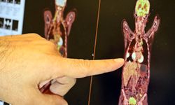 Prof. Dr. Ali Murat Tatlı’dan akciğer uyarısı