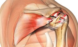 Tedavi edilmeyen omuz ağrıları kalıcı hasara yol açabilir