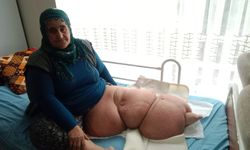 Fil hastalığı nedeniyle bacağı 100 kilo olan kadın tedavisi için destek bekliyor