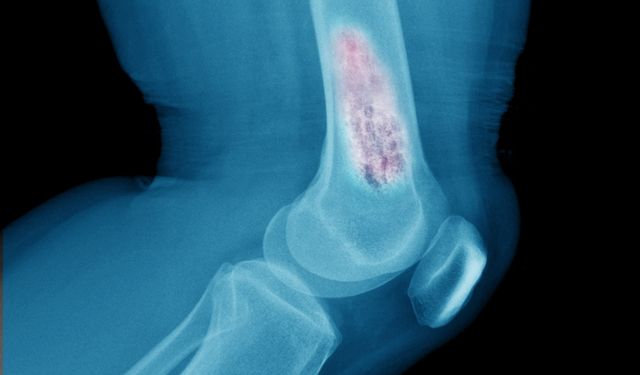 Kemiklerin sessiz düşmanı osteoporoz yaşam kaybına bile neden olabiliyor