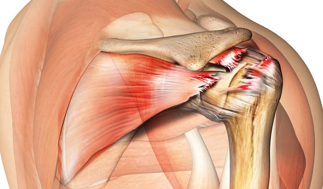 Tedavi edilmeyen omuz ağrıları kalıcı hasara yol açabilir