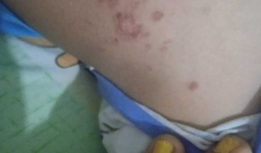 Gazipaşa'da 9 yaşındaki çocukta deniz kaynaklı enfeksiyon şüphesi