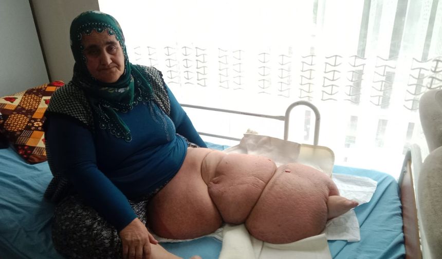 Fil hastalığı nedeniyle bacağı 100 kilo olan kadın tedavisi için destek bekliyor